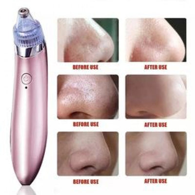 Electric Blackhead Acne Oil Remover Vacuum